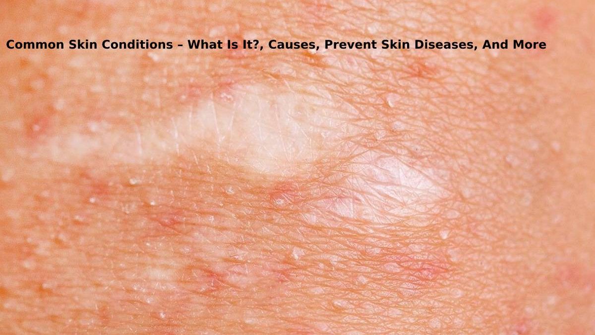 Common Skin Conditions – What Is It?, Causes, Prevent Skin Diseases, And More