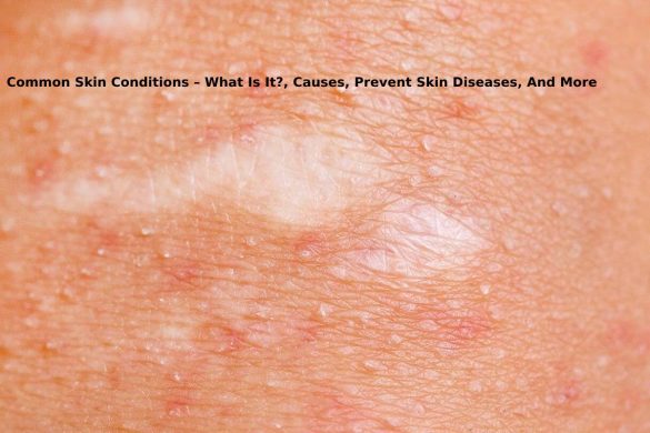 Common Skin Conditions