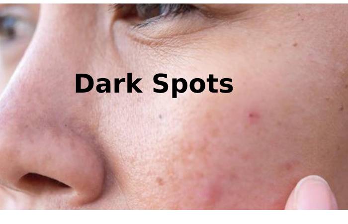 Dark Spots
