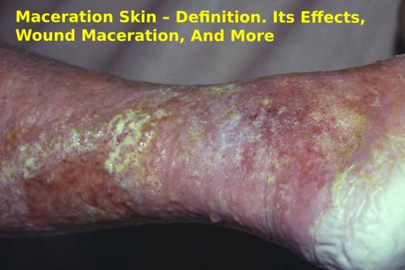 Maceration Skin
