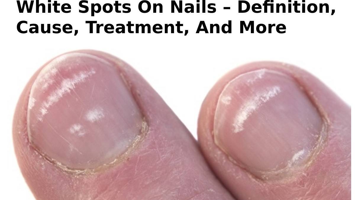 White Spots On Nails – Definition, Cause, Treatment, And More